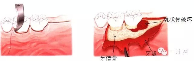 什么是牙周组织疾病，如何发生？