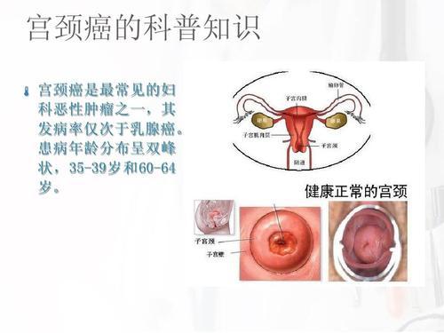 宫颈癌淋巴结转移因素分析论文