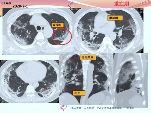 关于新的冠状动脉病毒肺炎组成：它可以治疗吗？_250字